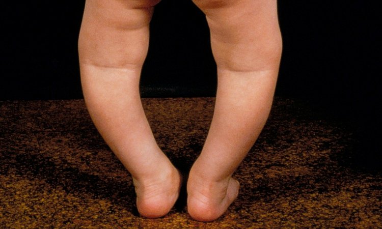 Д аминдэмийн дутагдлаас хүүхдийн хөл “о”, “х” хэлбэртэй болдог