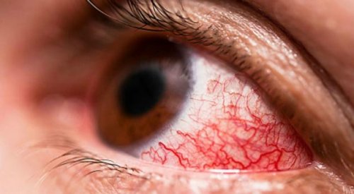 Ковид яагаад нүдийг өвчлүүлж байна вэ, нүдээ хэрхэн ХАМГААЛАХ вэ?