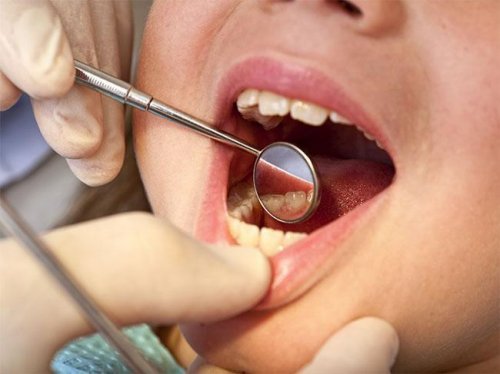 Хүүхдийн өвчлөлийн 75.9 хувийг шүд цоорох өвчин эзэлж байна